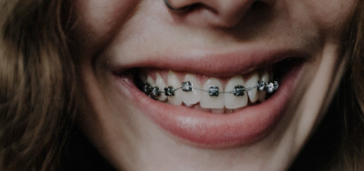 Dientes alineados con ortodoncia (Foto. Pexels)