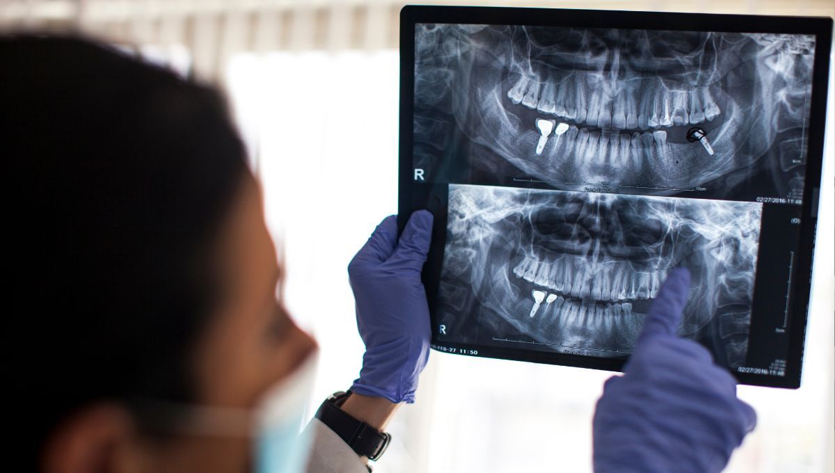 Radiografia paciente con implantes dentales (Fuente: Canva)