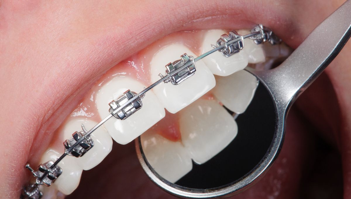 Paciente con tratamiento de ortodoncia en la consulta del dentista (Fuente: Canva)