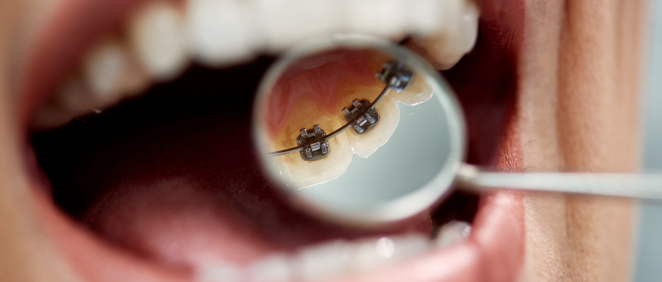 Paciente con ortodoncia lingual (Fuente: Canva)