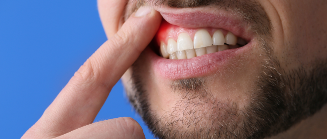 Hombre con periodontitis (Fuente: Canva)