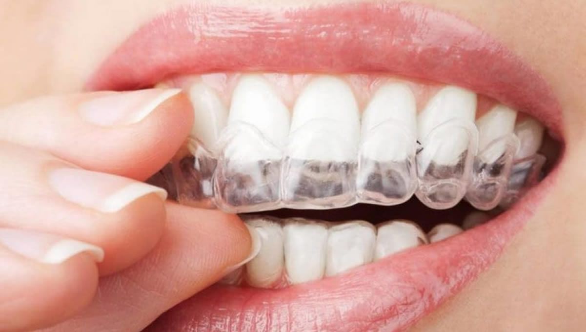 Mujer usando alineador transparente con un tratamiento de ortodoncia a distancia (Fuente: Consejo de Dentistas)