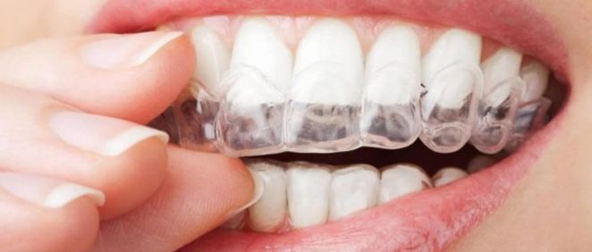 Mujer usando alineador transparente con un tratamiento de ortodoncia a distancia (Fuente: Consejo de Dentistas)