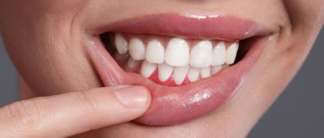 Paciente con enfermedad periodontal, sobre la que las estatinas tienen un importante impacto (Fuente: Canva)