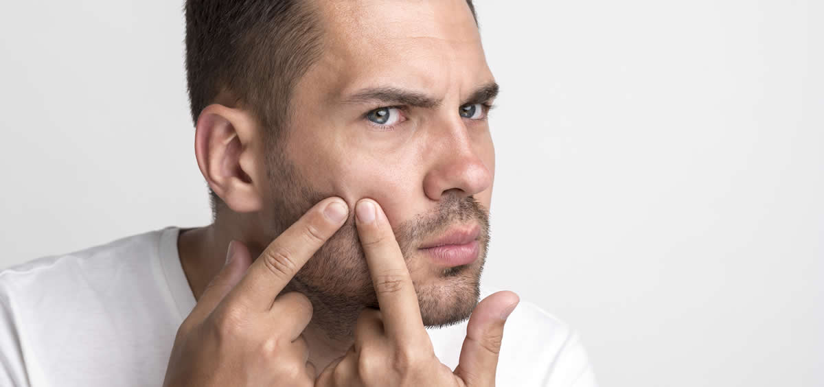 Casi un 30% de la población adulta se enfrenta al acné (Foto. Freepik)