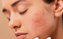 Cuidado de la piel con acné (Foto, Estetic)