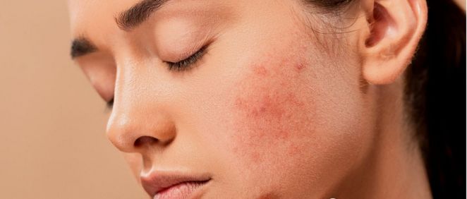 Cuidado de la piel con acné (Foto, Estetic)