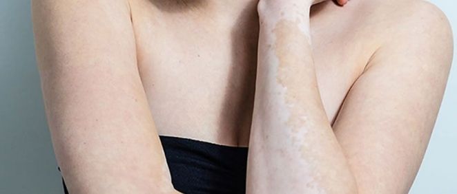 ¿Por qué la piel pierde pigmentación?