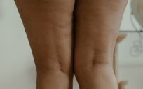 Celulitis en las piernas (Foto. Pexels)