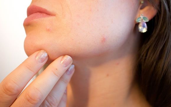 Radiofrecuencia, la tecnología que lucha contra el acné