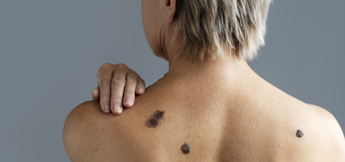 Mujer con cáncer de piel (Foto. Freepik)
