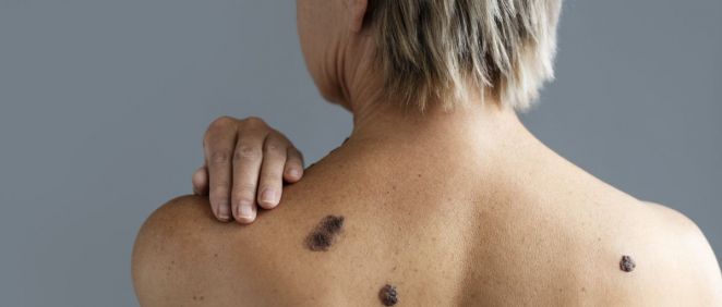 Mujer con cáncer de piel (Foto. Freepik)