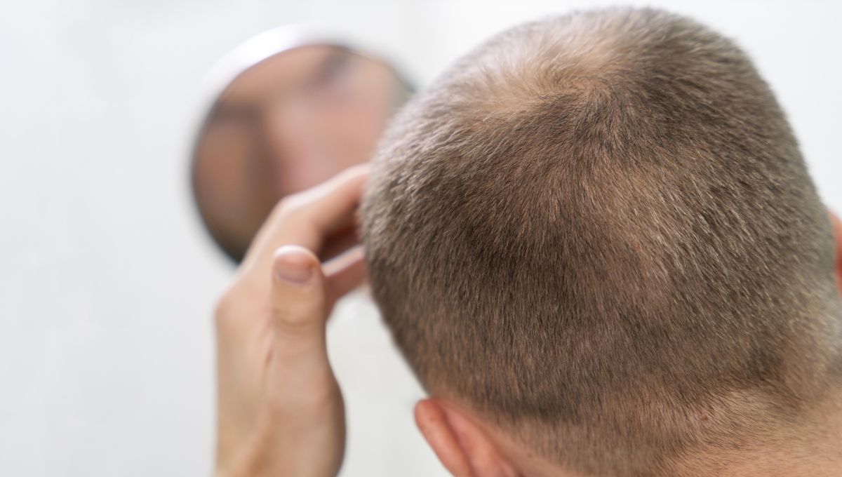 Hombre comprobando su nivel de alopecia (Foto. Freepik)
