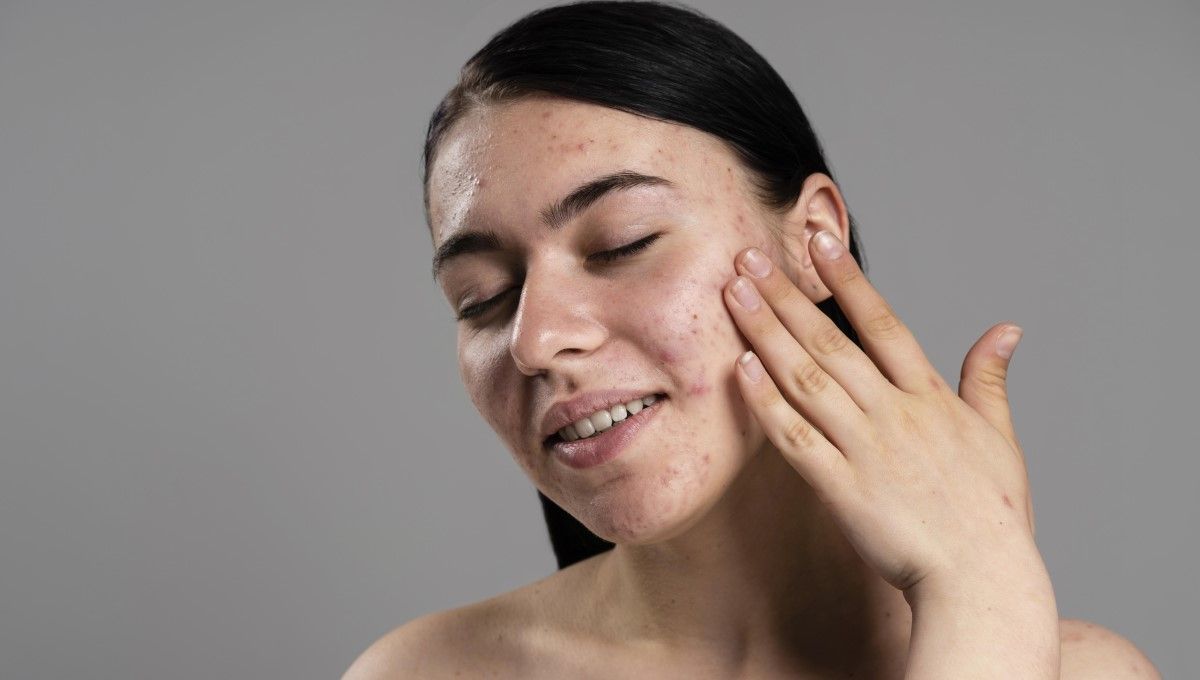 Mujer con acné en la cara (Foto. Freepik)
