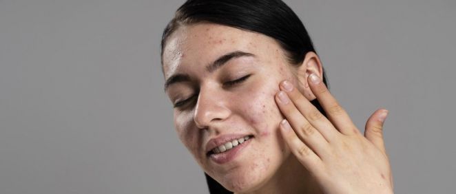 Mujer con acné en la cara (Foto. Freepik)