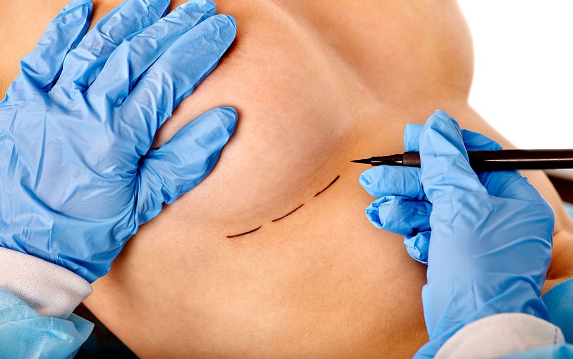 Aumento de pecho, mitos y verdades sobre esta cirugía