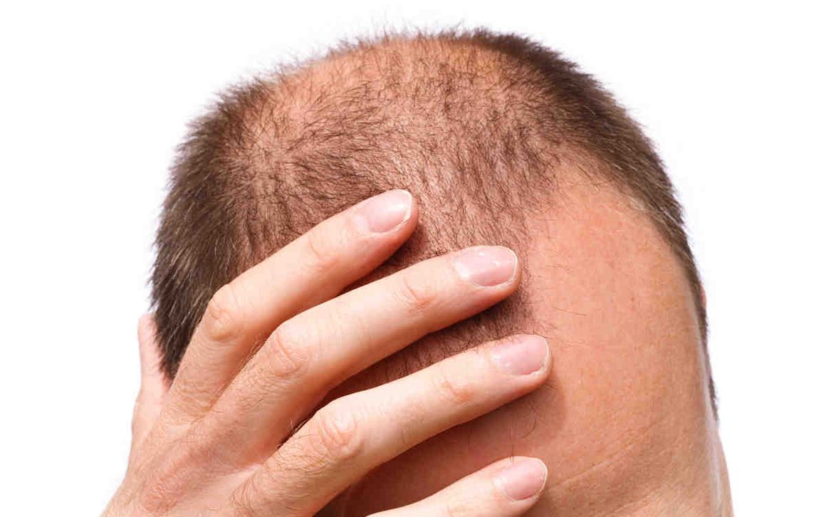 Alopecia, ¿cuál es la última tecnología para combatirla?
