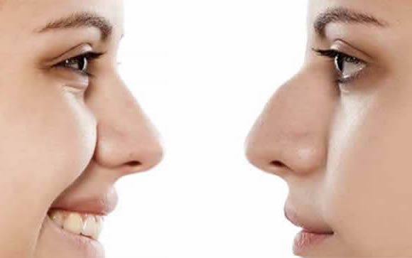 ¿Cómo retocar la nariz de forma mínimamente invasiva? 
