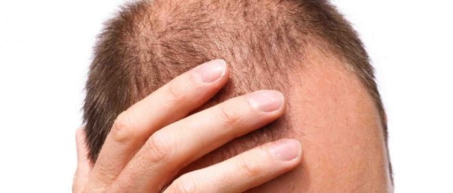Alopecia, ¿cuál es la última tecnología para combatirla?