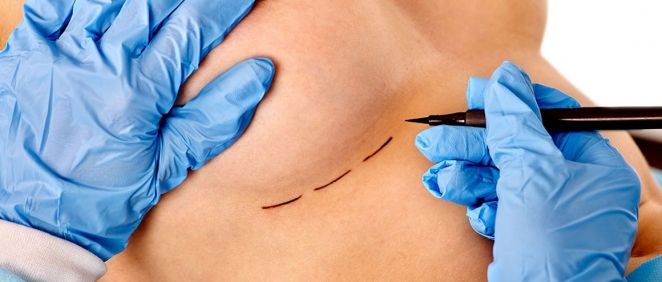 Aumento de pecho, mitos y verdades sobre esta cirugía