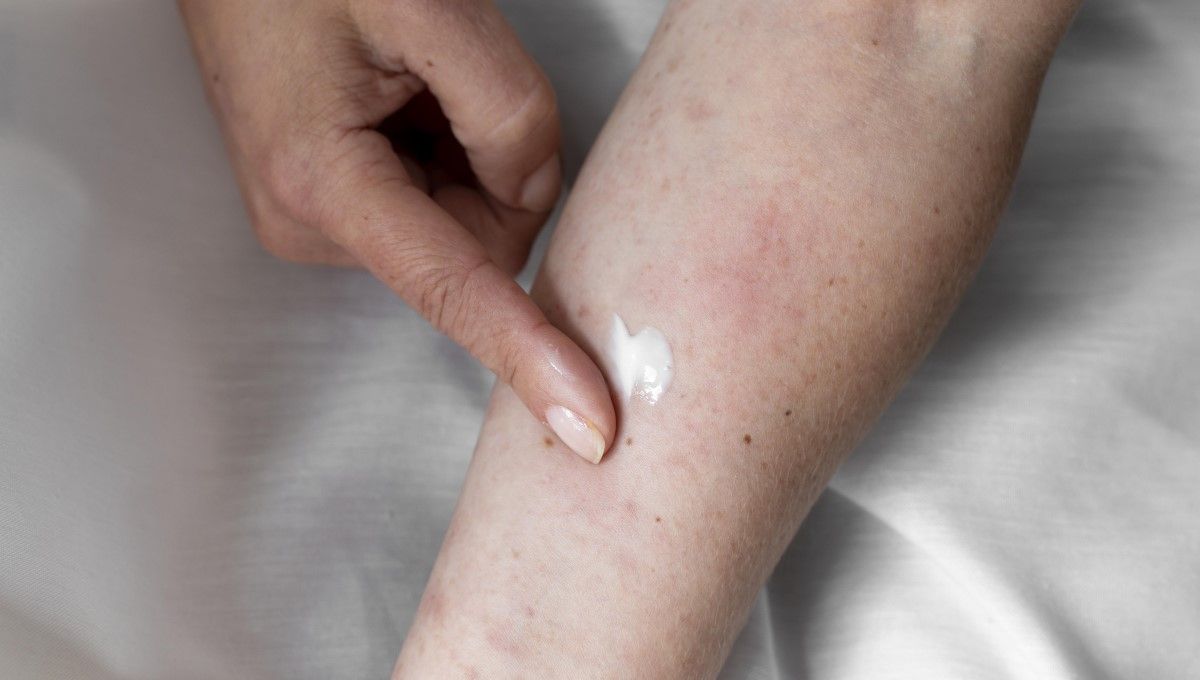 Dermatitis atópica (Foto. Freepik)