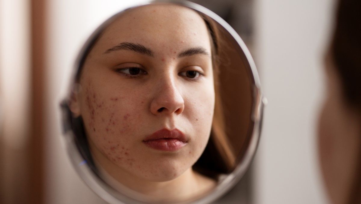 Mujer con acné mirando su reflejo en el espejo (Foto. Freepik)