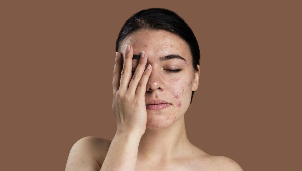 Mujer con un brote de acné (Foto. Freepik)