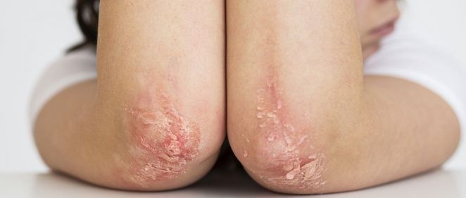 Dermatitis en los codos (Foto. Freepik)