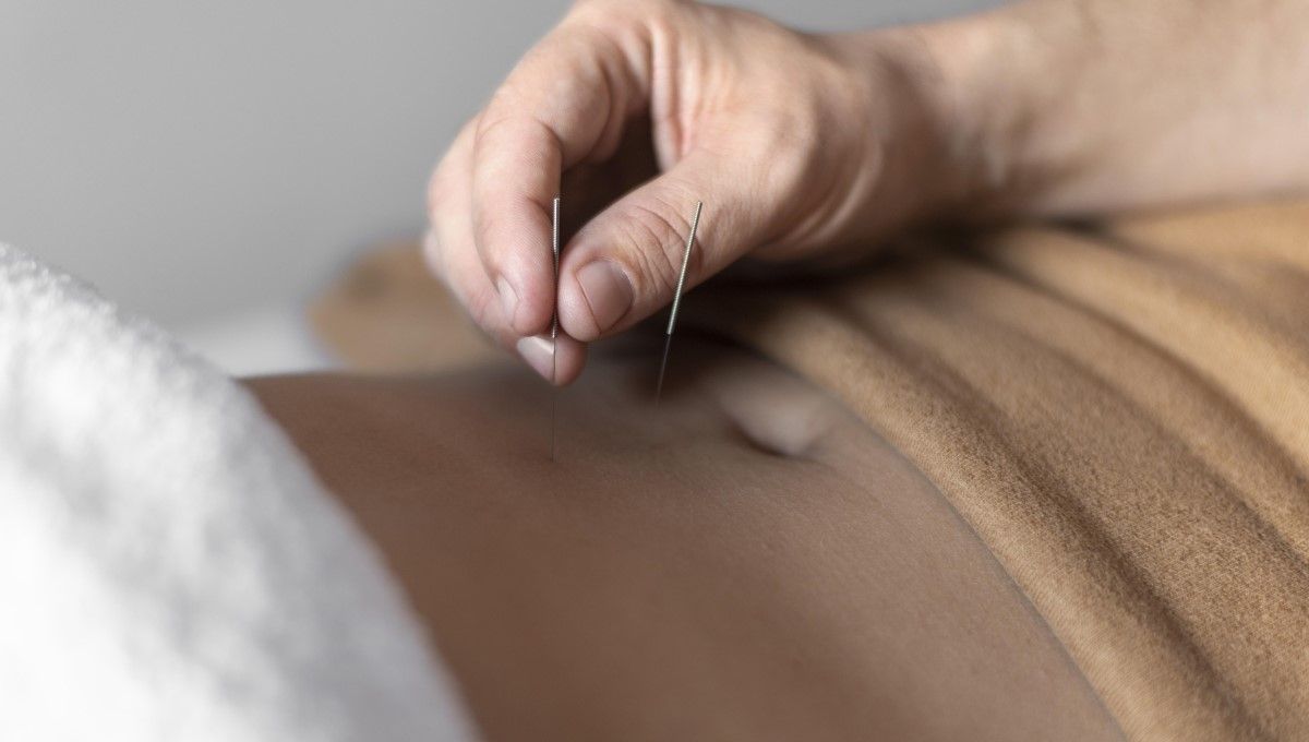 Inserción de aguja de acupuntura en el abdomen (Foto. Freepik)