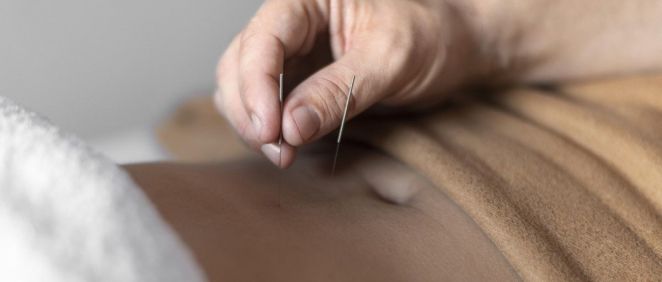 Inserción de aguja de acupuntura en el abdomen (Foto. Freepik)