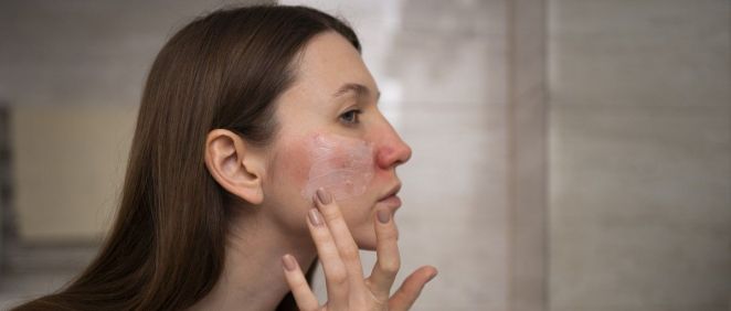 Mujer con rosácea aplicando crema en su rostro (Foto. Freepik)