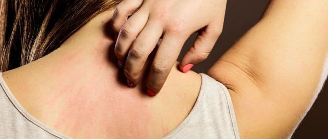 La dermatitis atópica empeora durante el otoño