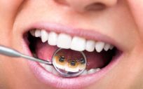 Existen cinco problemas dentales muy comunes entre la población