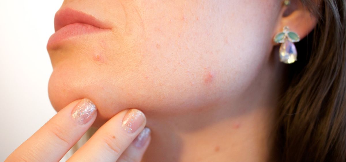 El acné puede ser un verdadero quebradero de cabeza para aquellos que lo sufren