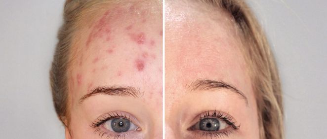 Antes y después de someterse al tratamiento de terapia biofotónica para el acné.