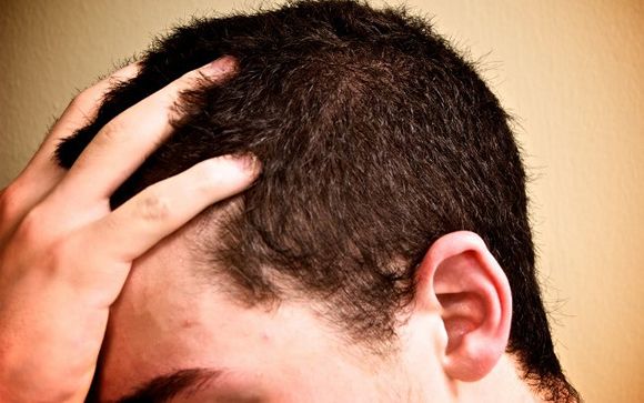 Los hombres no abandonan los tratamientos de alopecia por problemas sexuales