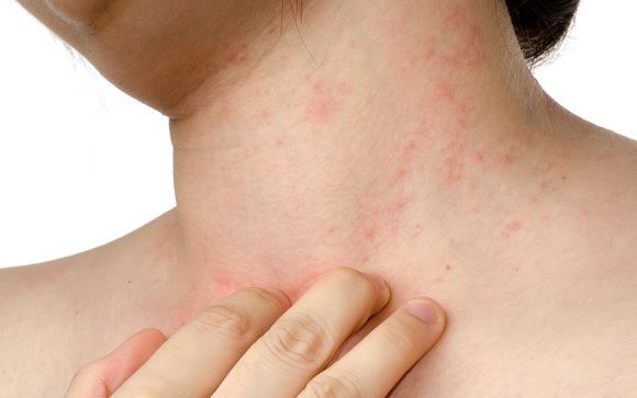 ¿Conoces los distintos tipos de dermatitis?