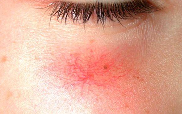 Cuperosis, ¿qué es y cómo afecta a la piel?