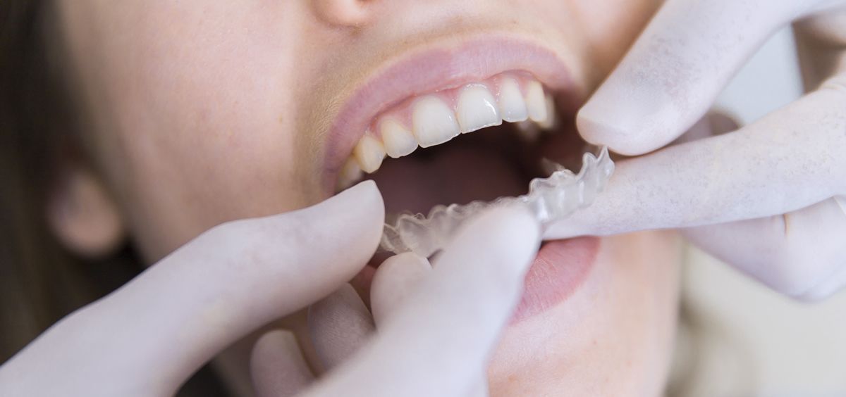 Los primeros días con cualquier sistema de ortodoncia es normal que cueste masticar