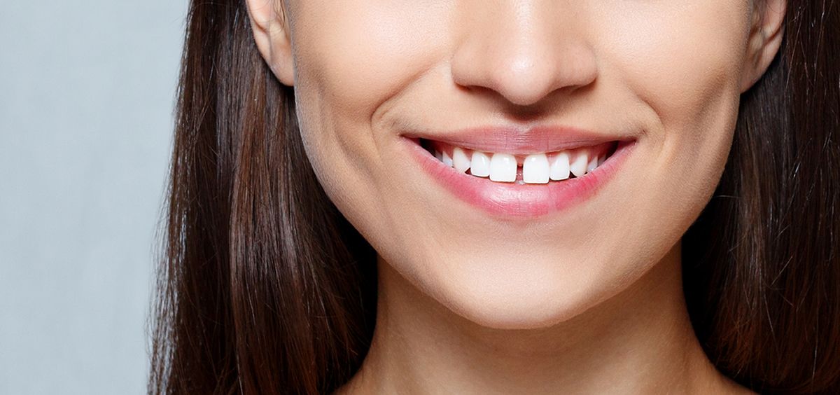 El diastema o separación entre los dientes centrales superiores, se ha convertido en los últimos años en una tendencia