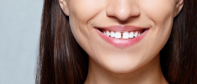 El diastema o separación entre los dientes centrales superiores, se ha convertido en los últimos años en una tendencia