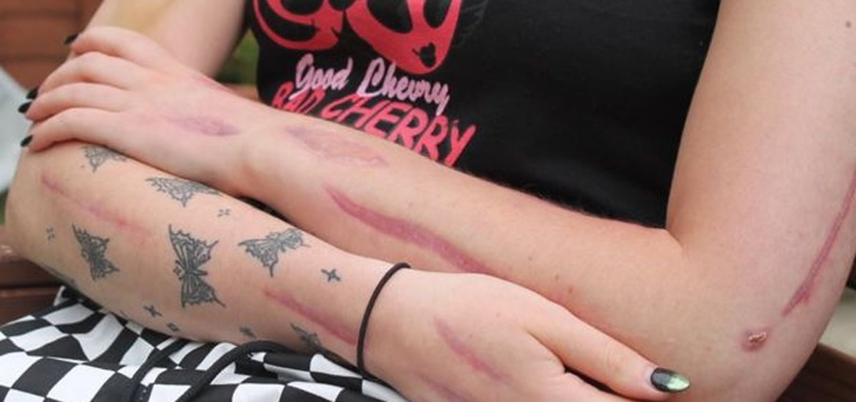 Los brazos de la joven con numerosas cicatrices tras las cirugías (Foto. BBC)