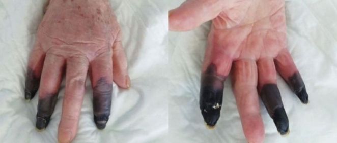 Amputan los dedos a una mujer por Covid 19 (Foto. European Journal of Vascular and Endovascular Surgery)