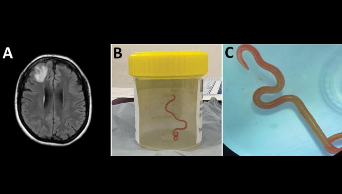 Detección de infección por nematodos Ophidascaris robertsi en una mujer de 64 años  (Foto. Emerging Infectious Diseases)