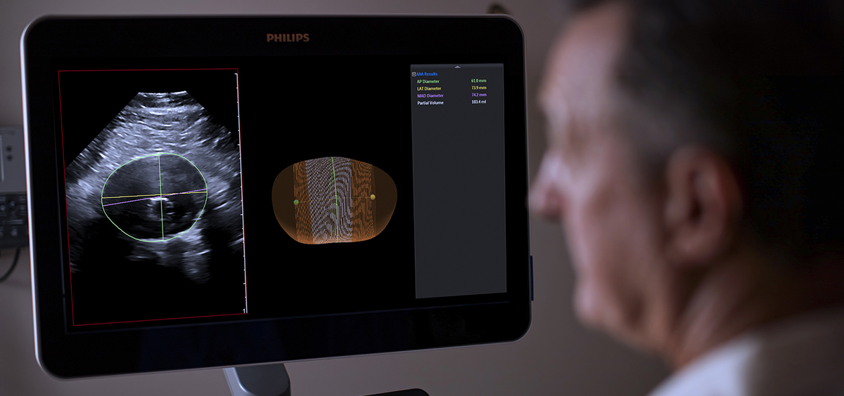 Philips integra el ultrasonido 3D para lograr un gran avance en la vigilancia de los aneurismas