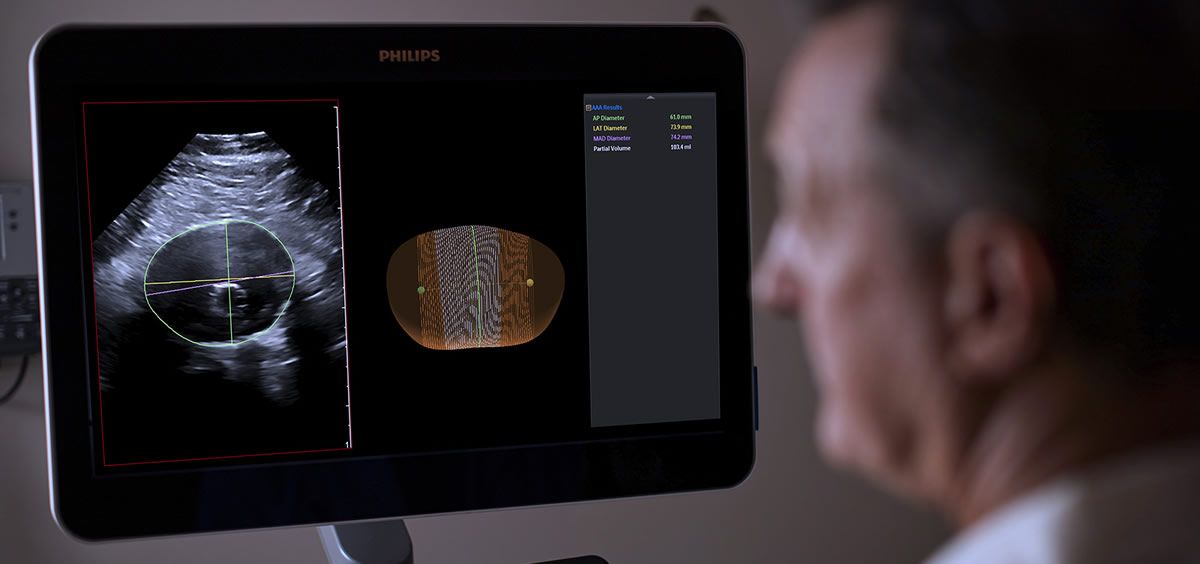 Philips logra avanzar en la vigilancia de los aneurismas de la aorta abdominal con el ultrasonido 3D