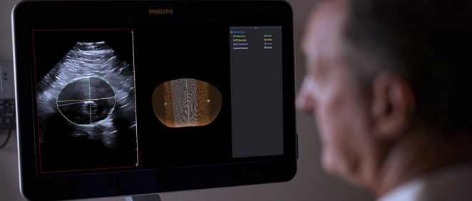 Philips logra avanzar en la vigilancia de los aneurismas de la aorta abdominal con el ultrasonido 3D
