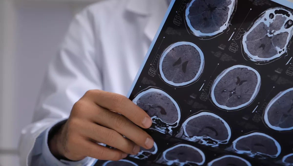 Profesional estudiando las imágenes de un cerebro con alzhéimer (Foto: Agencia Estatal de Investigación)