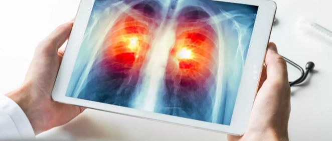 Radiografía de cáncer de pulmón. (Foto: ICAPEM - EP)