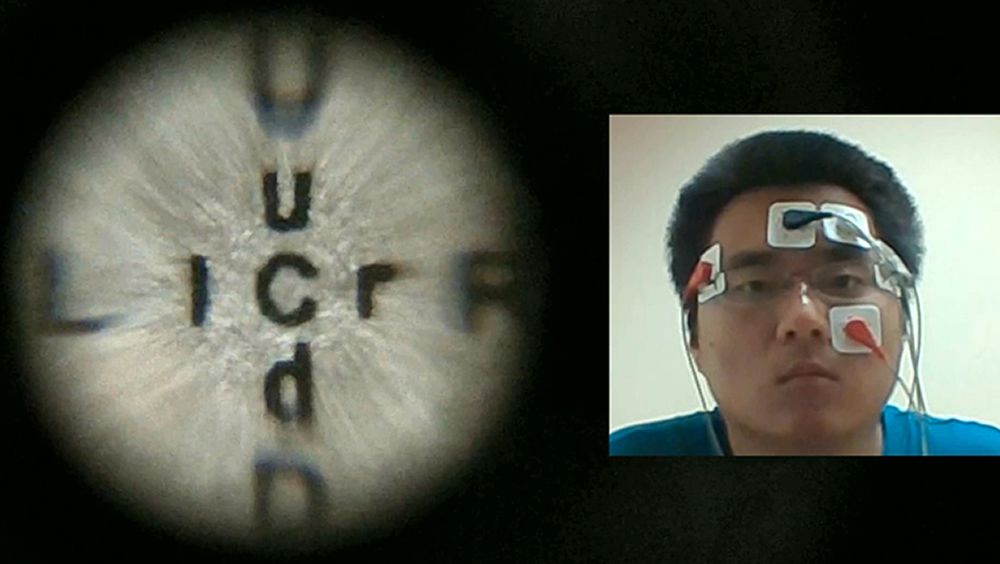 Ejemplo de la lente de contacto biomimética utilizada por un paciente (Foto: Universidad de California en San Diego)